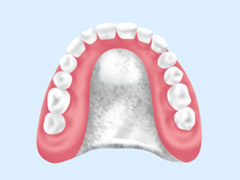 チタン床義歯　画像