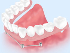インプラントオーバーデンチャー　画像