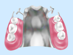 金属床義歯　画像